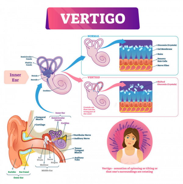 Vertigo And Dizziness In The Inner Ear Attune