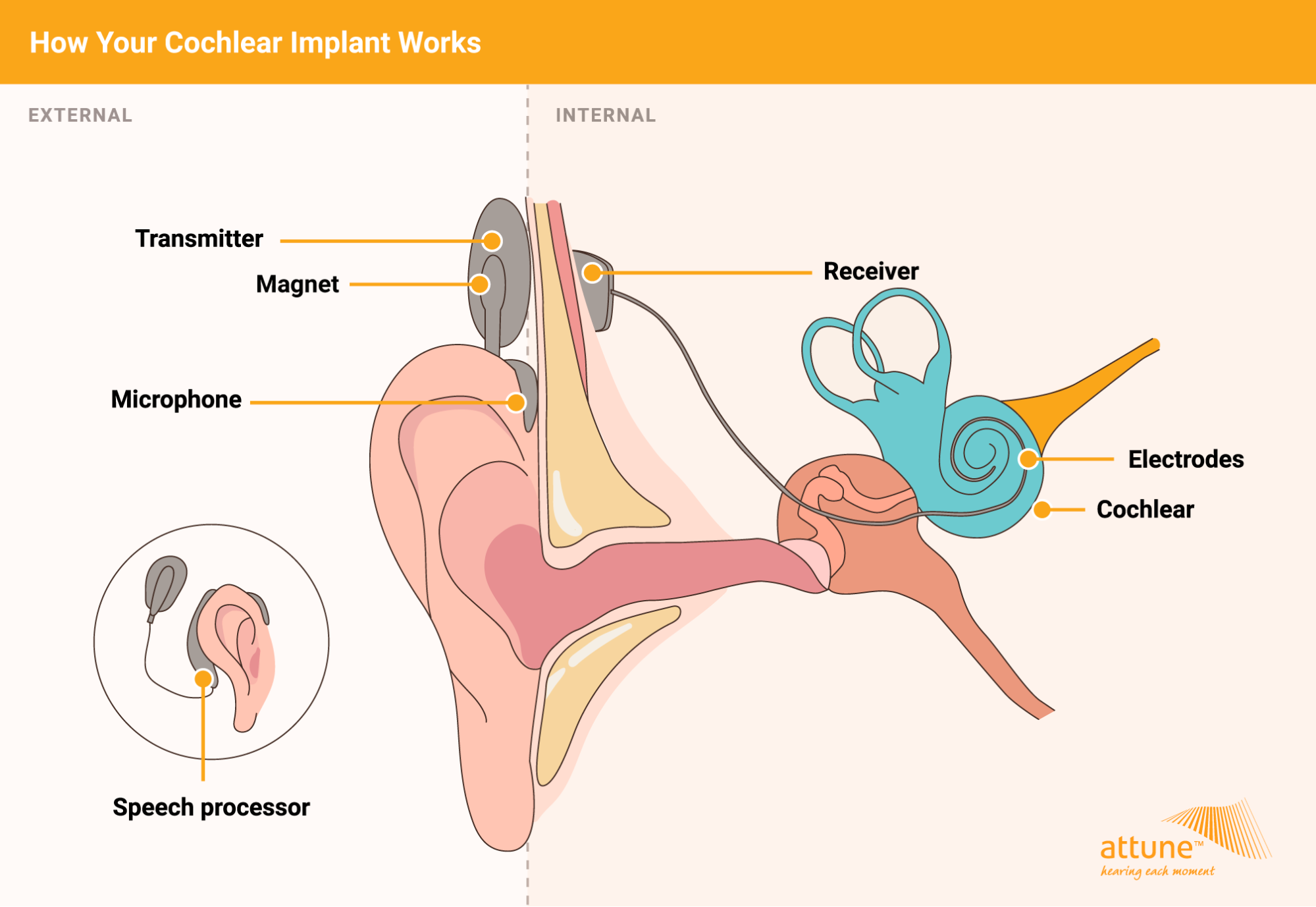 What are cochlear implants?