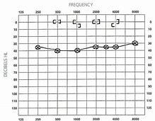 How To Read Your Audiogram Results