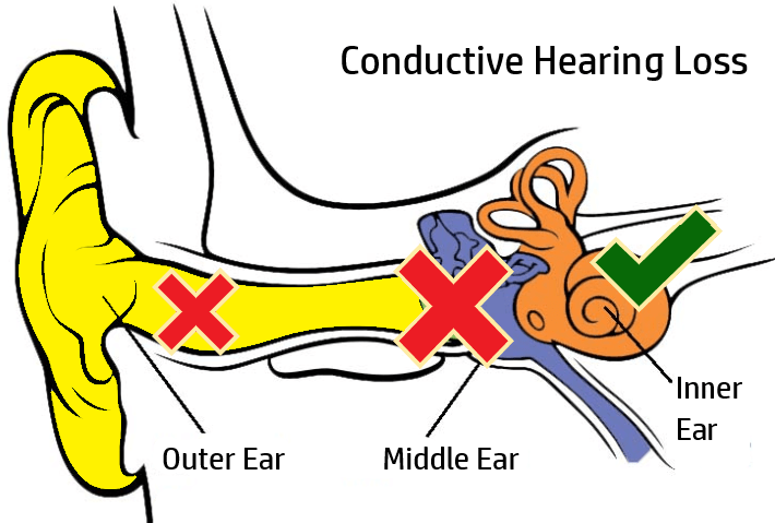 ¿Por qué no puedo oír? Tipos y causas de pérdida auditiva que necesita saber