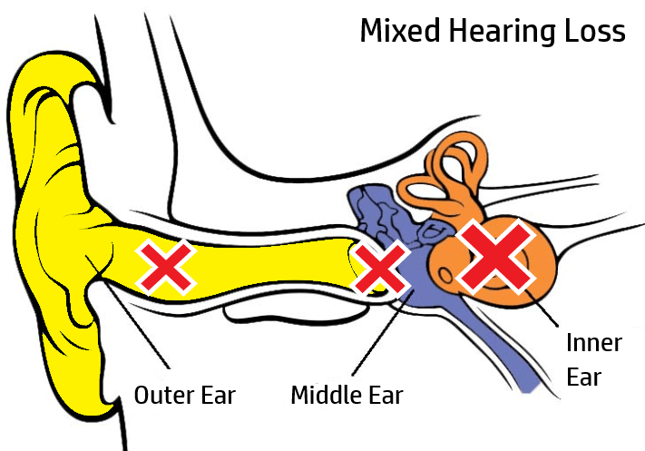 Severe to profound hearing loss