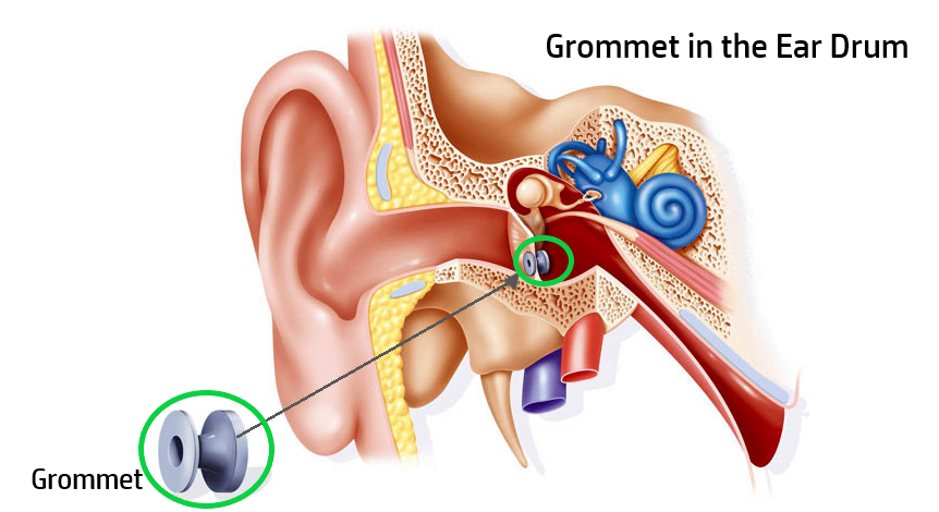 Grommet in the eardrum