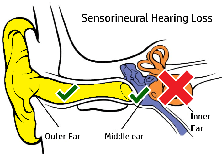 Sensorineural hearing loss