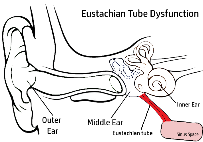 eustachian tube dysfunction