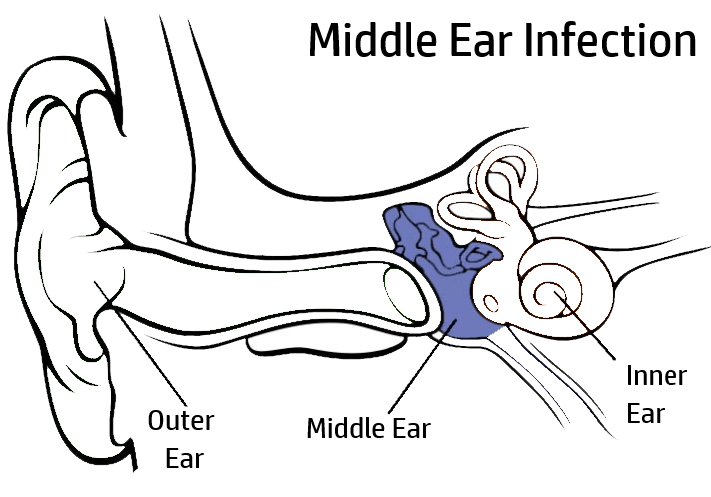 middle ear infection