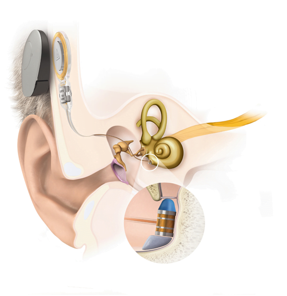 middle ear implant cost