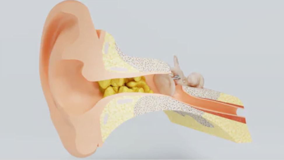 How to remove ear wax from hearing aids