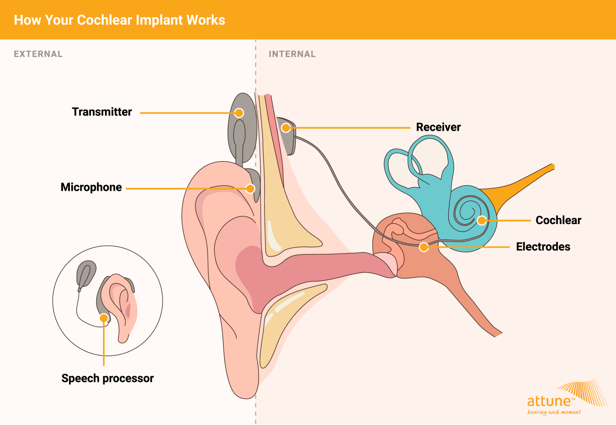 how your cochlear implant works